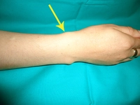 Tendon Sıkışması Belirtileri ve Tedavisi