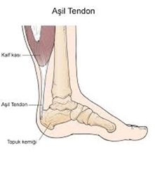 Aşil Tendonu İltihabı Belirtileri ve Tedavisi