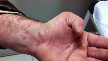 Parmak Tendon Kopması Belirtileri ve Tedavisi