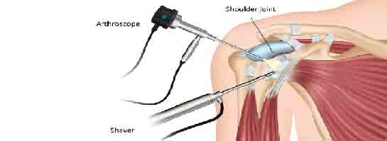 Omuz Tendon Ameliyat