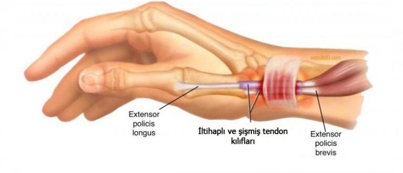 Parmak Tendon Ameliyat