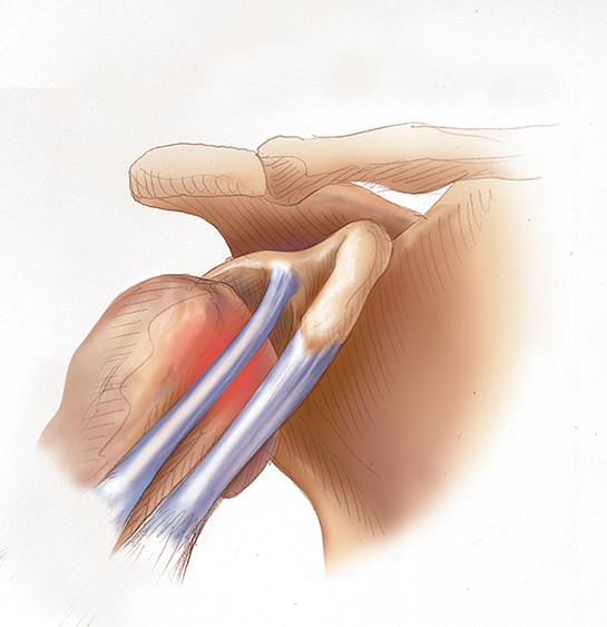 Tendon İltihabı Belirtileri ve Tedavisi
